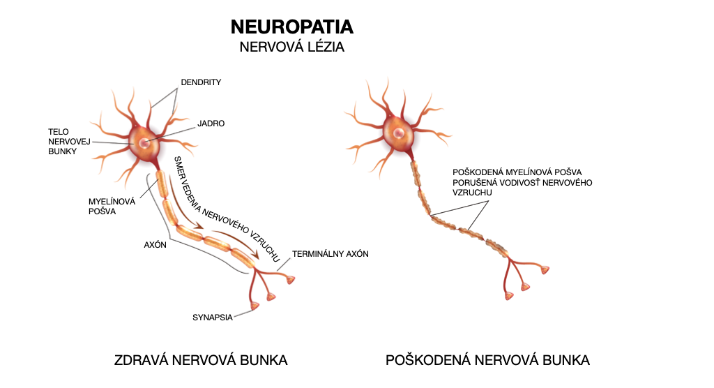 Neuropatia